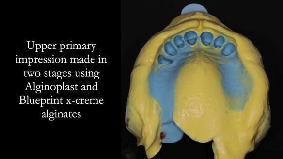 Newsletter 56 showing the making and fitting of a bilateral free end saddle upper removable partial denture (RPD) for patient with pemphigus