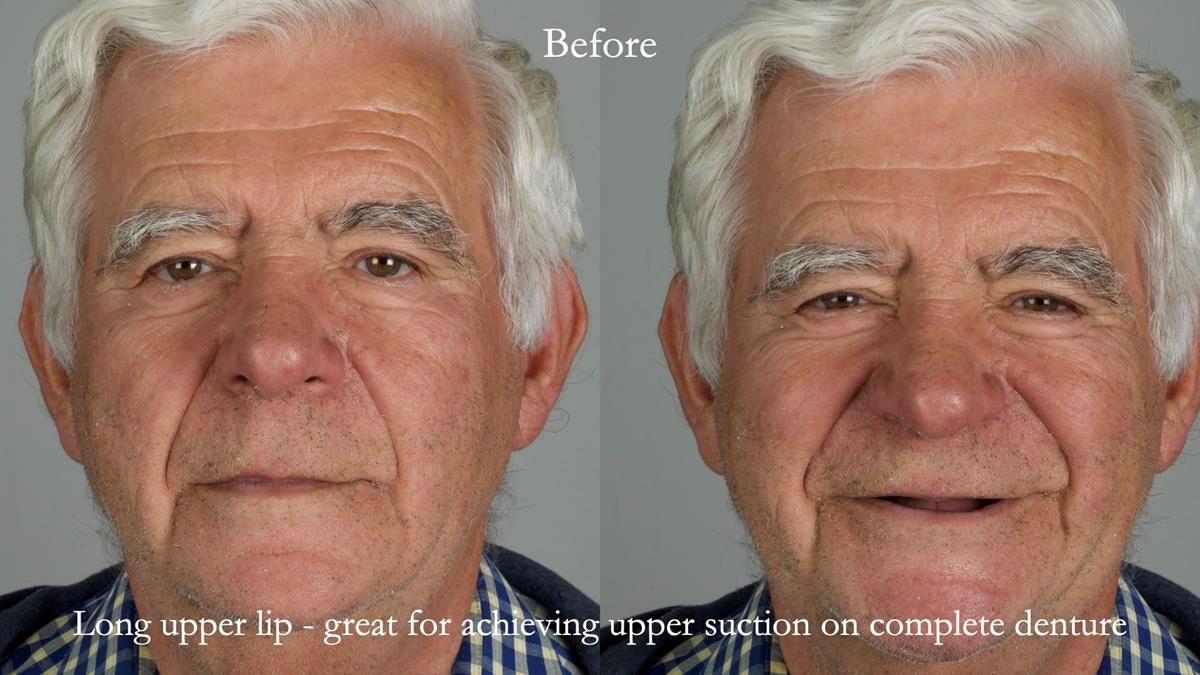 Fin’s Newsletter 88 — Complete dentures - full protocol… he rearranged his own teeth!