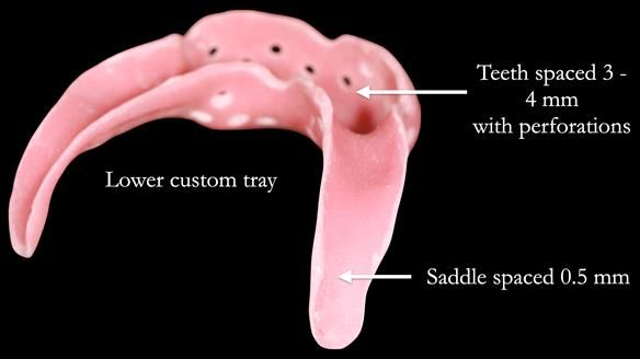 Newsletter 52 Managing Jo’s failing dentition with extractions and Mk 1/Mk 2 complete upper dentures and lower partial dentures FULL PROTOCOL