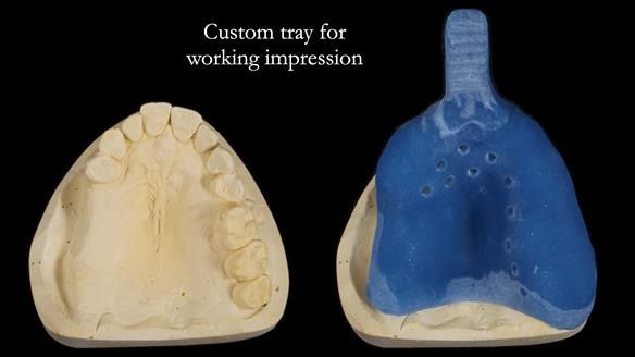 Finlay's Newsletter 64 case study - provision of a Kennedy class 2 metal based Scandinavian RPD for Ian