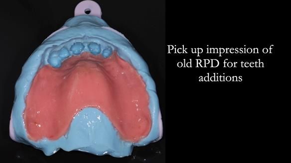 Finlay's Newsletter 62 provision of extractions and metal based complete dentures for Rafique