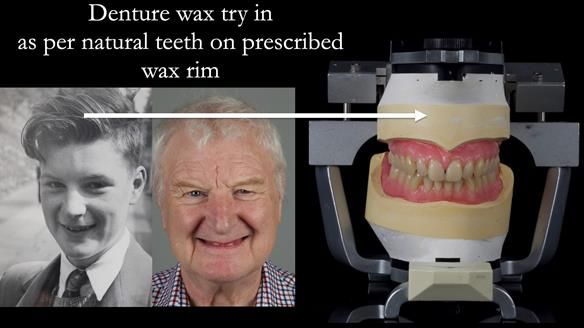 Newsletter 57 showcases the making and fitting process of implant-supported complete dentures for Alisdair