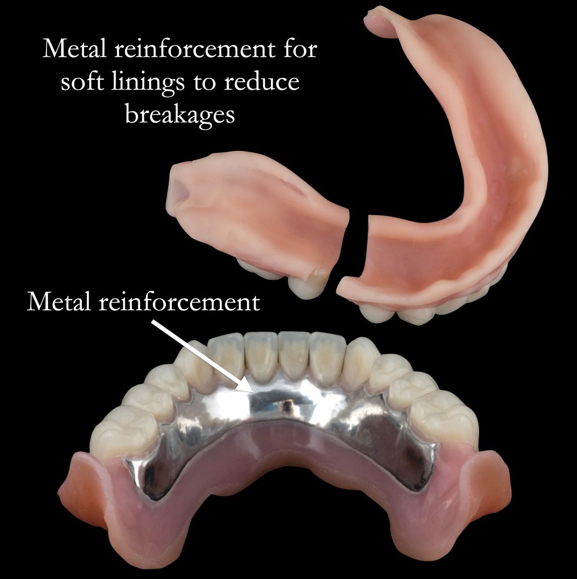 Soft linings (Molloplast B) with complete dentures need metal reinforcement
