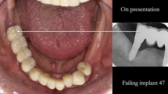 Ken – going downhill, first class