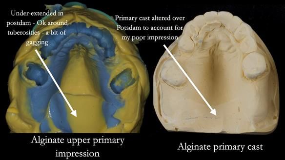 Newsletter 77: Jeremy’s case – immediate complete upper denture