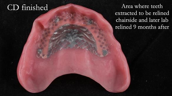 Finlay's Newsletter 62 provision of extractions and metal based complete dentures for Rafique