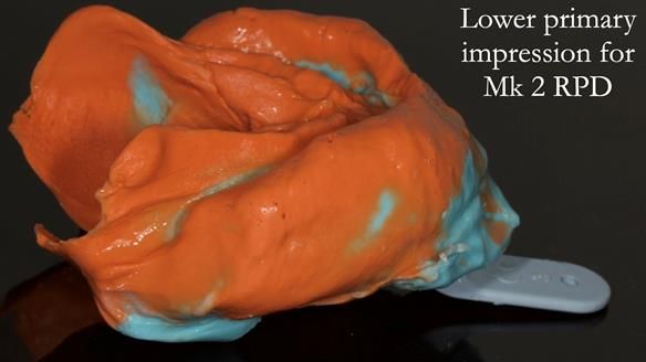 Finlay's Case Study Newsletter 40 - Immediate Mk 1 RPD to Definitive Mk 2 RPD - full protocol