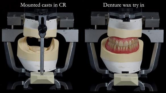 Newsletter 83: Sheila’s Complete Denture Success
