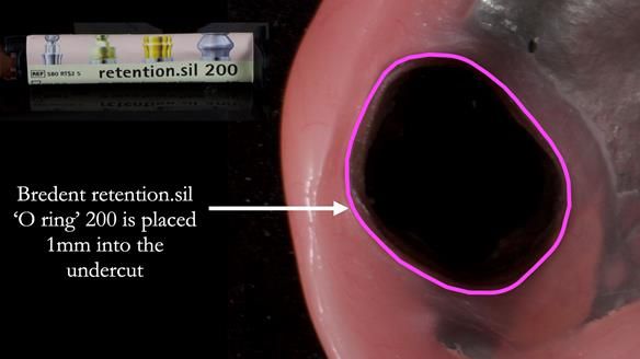 Finlay's Newsletter 58 Gasket upper partial denture for Zoe