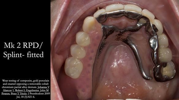Newsletter 51 Managing Anne’s failing dentition with distal extension base RPD/Splint FULL PROTOCOL