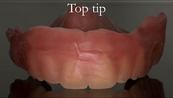 Figure 40 A sheet of wax (1.5mm) is placed on the labial aspect of the upper denture - with 1mm of peripheral roll exposed to allow the reline material to adhere