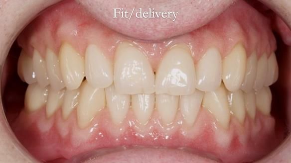 Newsletter 57 showcases the making and fitting process of implant-supported complete dentures for Alisdair