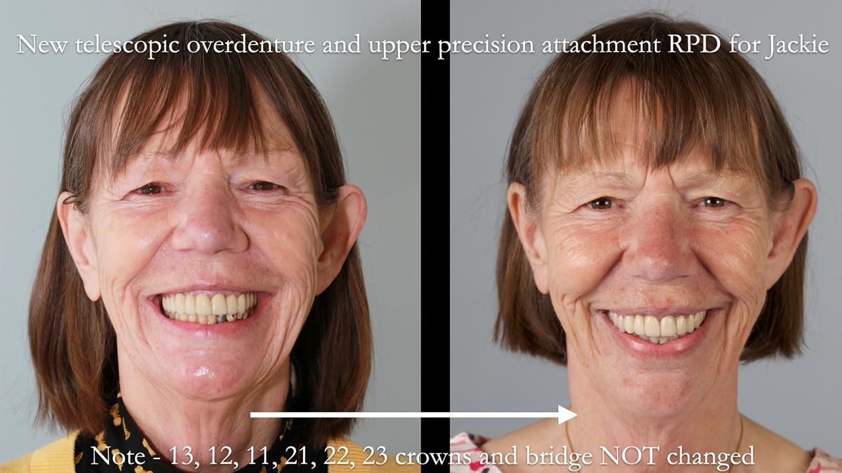Newsletter 76: Jackie’s case – Telescopic overdenture & precision RPD (the tricky truth!)