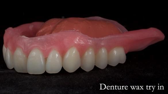 Newsletter 70 Complete Denture Treatment for Kate: A Case Study on Natural-Looking Dentures and Implant-Supported Overdentures
