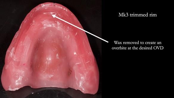 Newsletter 77: Jeremy’s case – immediate complete upper denture