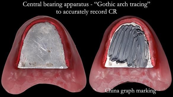 Replacing Madeline’s Complete denture FULL PROTOCOL