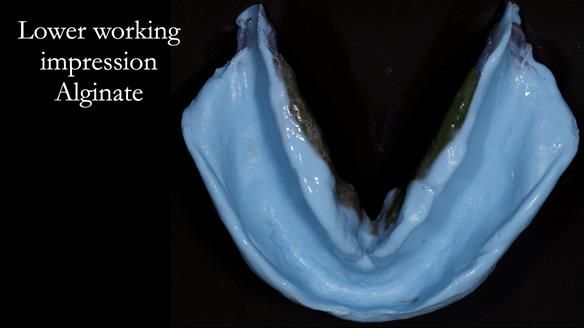 Newsletter 53 showing the making and fitting of ultra life-like dentures for Valena