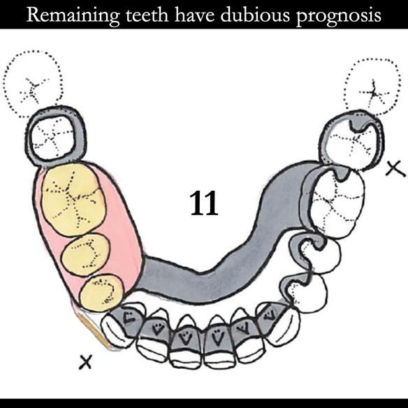 Universal Scandinavian partial denture designs