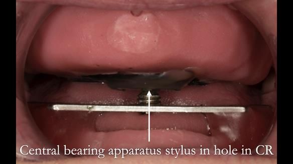 Newsletter 75: Marion’s case - Step-by-step complete denture workflow