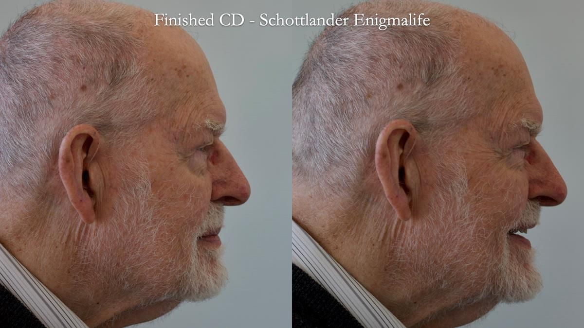 Newsletter 87 – Father Peter: A Partial Denture that needed Minor Miracle