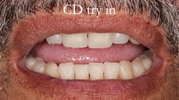 Finlay's Newsletter 62 provision of extractions and metal based complete dentures for Rafique
