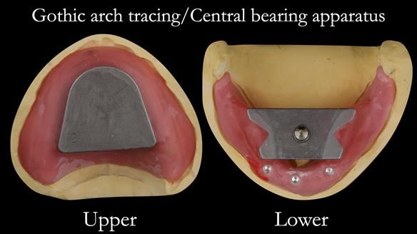 Part 2 of visit 4 - Gothic arch tracing - made to fit accurately the working casts - using light cured tray maker material. This allows precise recording of the centric relation - much better than wax blocks