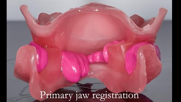 Complete denture Class II div 2 deep overbite Newsletter 39