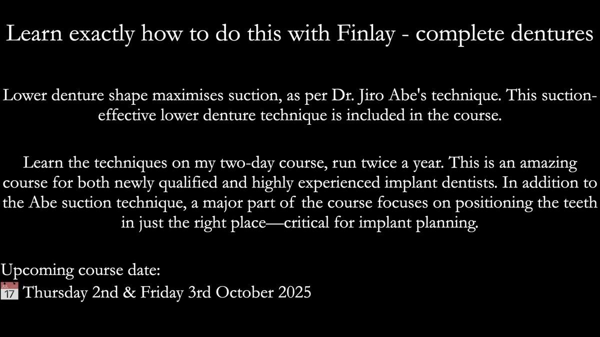 Newsletter 76: Jackie’s case – Telescopic overdenture & precision RPD (the tricky truth!)