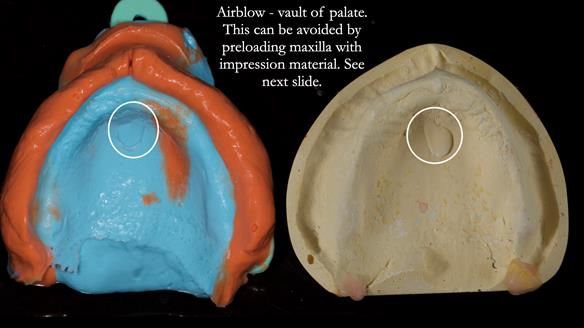 Newsletter 82 Mary - A complete upper and a one-tooth gasket denture