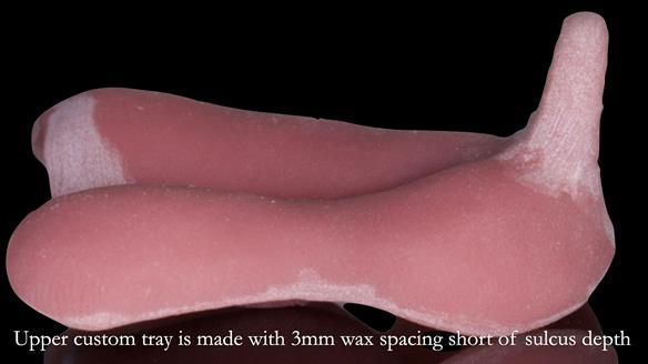 Newsletter 54 case presentation upper complete denture and lower Scandinavian designed hygienic partial denture for David