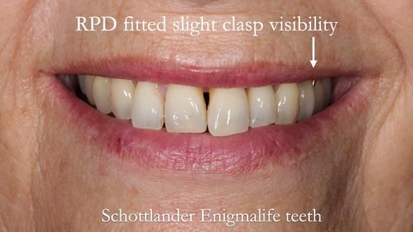 Newsletter 56 showing the making and fitting of a bilateral free end saddle upper removable partial denture (RPD) for patient with pemphigus