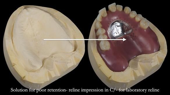 Newsletter 53 showing the making and fitting of ultra life-like dentures for Valena
