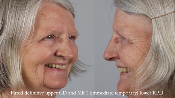 Newsletter 82 Mary - A complete upper and a one-tooth gasket denture