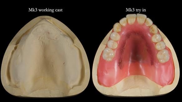 Newsletter 77: Jeremy’s case – immediate complete upper denture