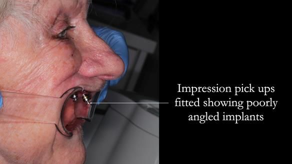 Newsletter 65 Marisa Provision of Complete Dentures on badly placed implants