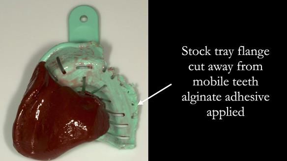 Finlay's Case Study Newsletter 40 - Immediate Mk 1 RPD to Definitive Mk 2 RPD - full protocol