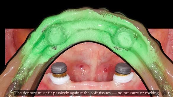 Newsletter 78: What do Clark Gable and a Locator® overdenture have in common?