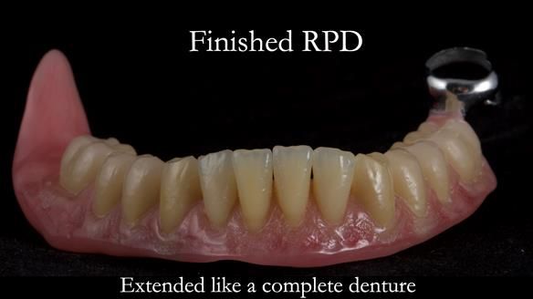 Finlay's Newsletter 59 Ultra hard partial dentures made for Gill