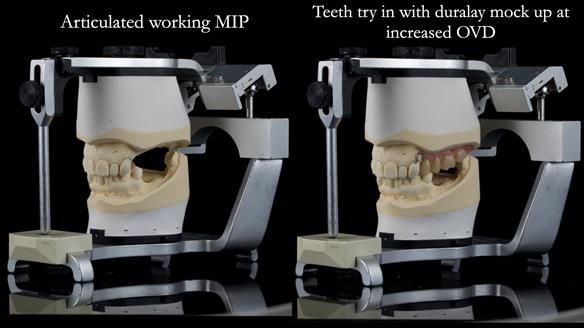 Finlay's Newsletter 60 Sylvia's upper Kennedy Class 2 Mod 1 metal based upper RPD