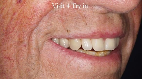 Newsletter 54 case presentation upper complete denture and lower Scandinavian designed hygienic partial denture for David