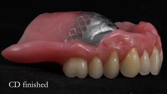 Finlay's Newsletter 62 provision of extractions and metal based complete dentures for Rafique