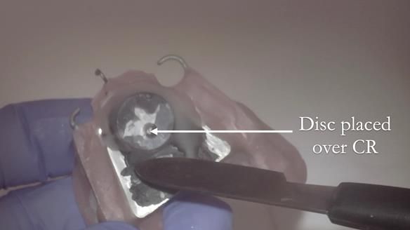 Finlay's Case Study Newsletter 40 - Immediate Mk 1 RPD to Definitive Mk 2 RPD - full protocol