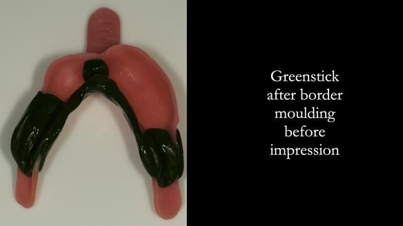 Newsletter 76: Jackie’s case – Telescopic overdenture & precision RPD (the tricky truth!)