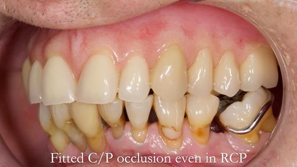Newsletter 54 case presentation upper complete denture and lower Scandinavian designed hygienic partial denture for David