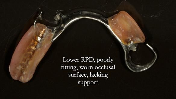 Eileen's transformation with upper and lower RPDs of Scandinavian hygienic design FULL PROTOCOL