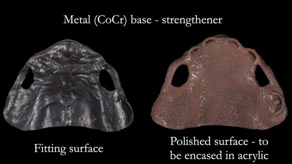 Newsletter 57 showcases the making and fitting process of implant-supported complete dentures for Alisdair