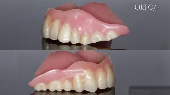 Newsletter 54 case presentation upper complete denture and lower Scandinavian designed hygienic partial denture for David