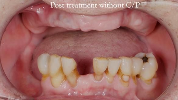 Newsletter 54 case presentation upper complete denture and lower Scandinavian designed hygienic partial denture for David