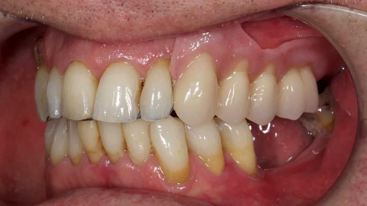 Newsletter 89 – Simon: A Challenging Kennedy Class II Division 1 Upper CoCr Partial Denture with a High Smile Line