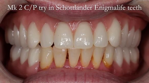 Newsletter 52 Managing Jo’s failing dentition with extractions and Mk 1/Mk 2 complete upper dentures and lower partial dentures FULL PROTOCOL